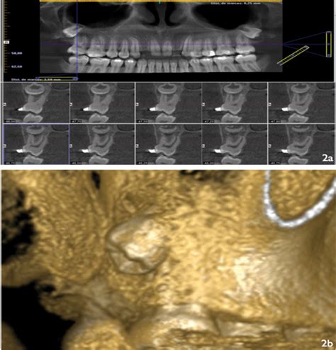 Usefulness Of Cone Beam Computed Tomography For The Diagnosis And