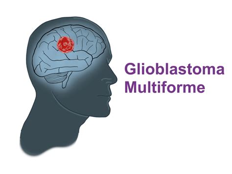 Glioblastoma Multiforme The Deadliest Brain Tumor Pro Doctor