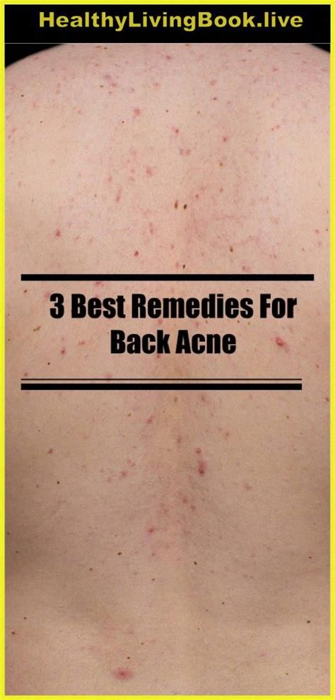 3 Best Remedies For Back Acne Back Acne Remedies Natural Acne