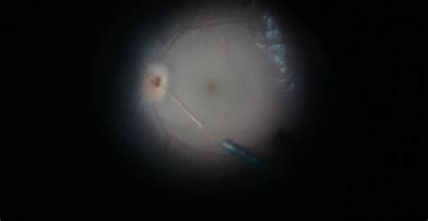 Severe Blunt Eye Trauma With Corneal Laceration And Foveal Sparing
