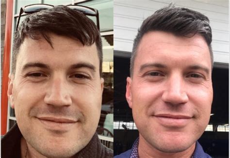 M33511” 20818721lbs Face Gains After 3 Weeks On Keto Diet And