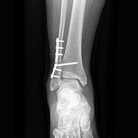 Ankle fracture - Weber C (post-operative) | Image | Radiopaedia.org