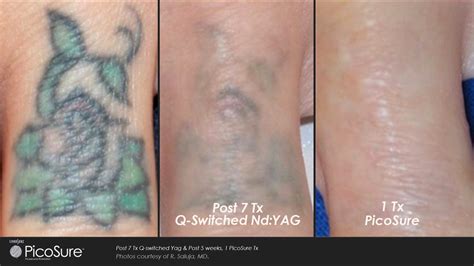 Laser Tattoo Removal With Picosure Laser Treatment Epilium And Skin