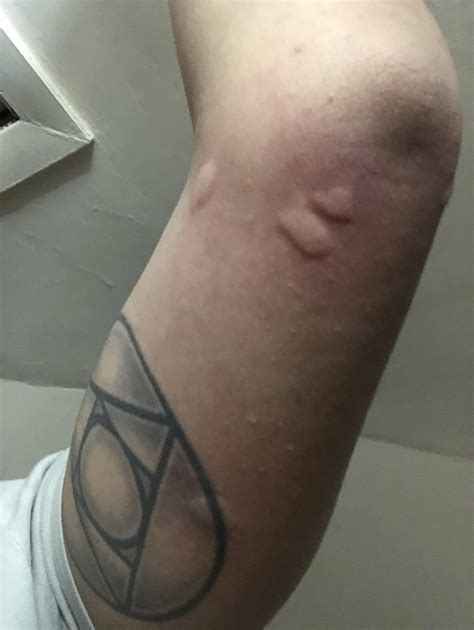 Healthdirect australia is a free service where you can talk to a nurse or doctor who can help you know what to do. Are these bed bug bites? Got them just before I went to ...