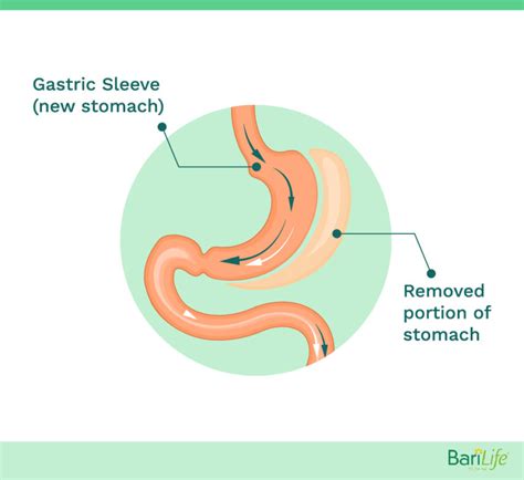 Medications To Avoid After Gastric Sleeve Surgery Important For Post Op