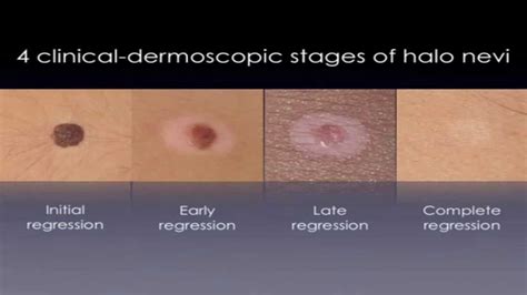 Skin Cancer Skin Cancer White Spots