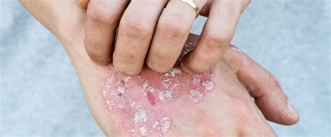 Identifying Your Rash Most 3 Common Skin Rash Types