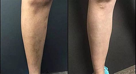Before And After Dallas Tx And Hurst Tx Dallas Vein Institute