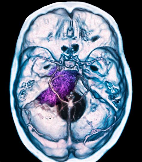 Signs And Symptoms Of Brain Tumors In Adults Include Severe Headaches