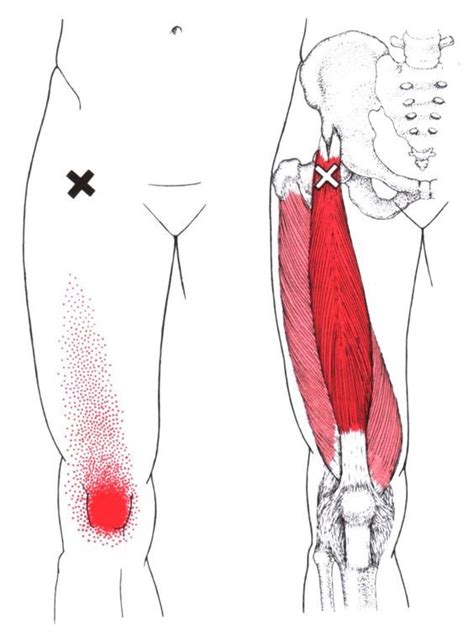 How do you massage sciatica with trigger points. Pin on Healing program for body injury