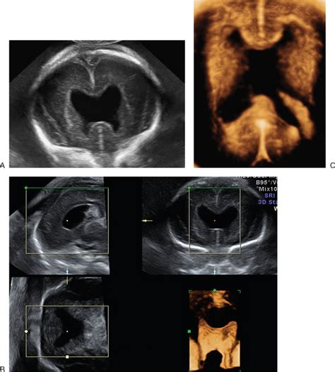 The Role Of Three Dimensional Ultrasound In The Evaluation Of The Fetus