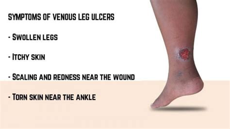 Venous Leg Ulcer Symptoms Causes And Prevention