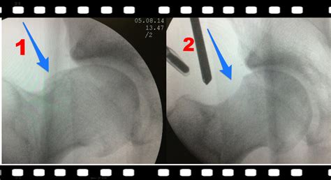 Impacto Femoroacetabular Do Quadril Ifa Dr David Gusm O