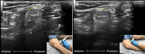 Dynamic Sonography For Snapping Knee Syndrome Caused By The Gracilis