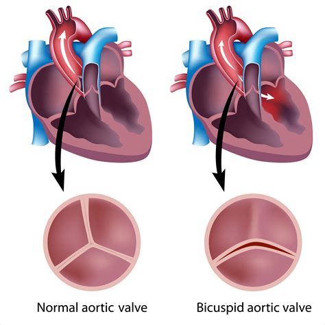 Normal Aortic Valve