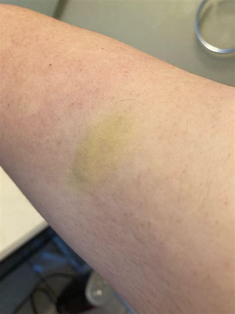 Yellow Spot On My Upper Arm I Thought It Was A Bruise At First But It