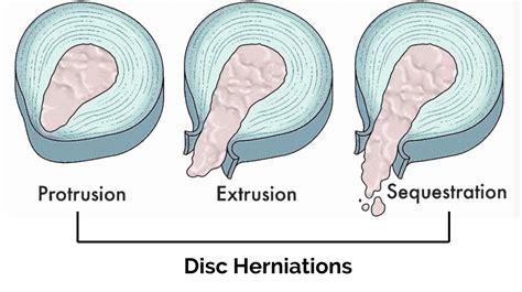 Types Of Herniated Discs Barbell Rehab