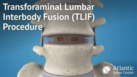 Transforaminal Lumbar Interbody Fusiontlif Procedure Youtube