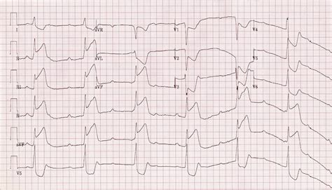 Inferior Stemi Litfl Ecg Library Diagnosis