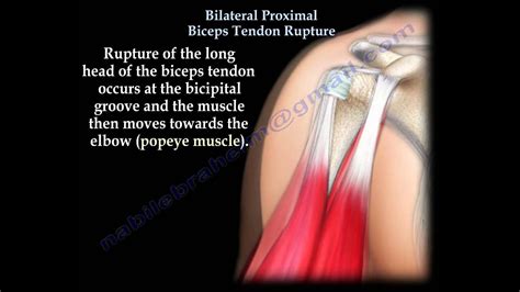 Bilateral Proximal Biceps Tendon Rupture Everything You Need To Know Dr Nabil Ebraheim