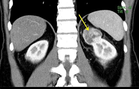 Renal Oncocytoma Radiology Cases