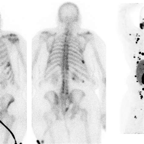 Contemporaneous Whole Body Bone Scan And 68 Ga Psma Petct In A Case Of