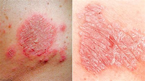 Is It Psoriasis Or Is It Eczema New Pain Free Test Can Tell
