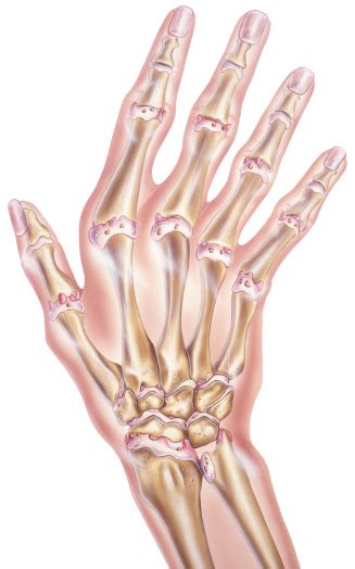 Noun don't stick your fingers in the cookie batter! Hand And Fingers Osteoarthritis Of The Joints Stock ...