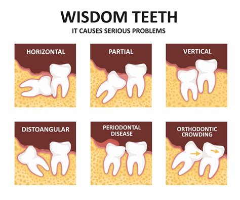What Happens When Wisdom Teeth Are Not Removed Canvaaaaaaaa
