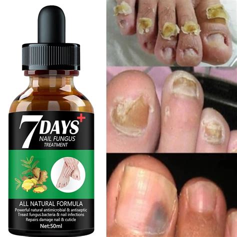 7days Nail Fungus Treatment Essence Serum Care Hand And Foot Care