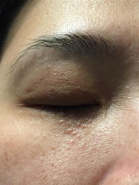 Skin Concerns My Aunt Has These Little Bumps Under Her Eyes For Years