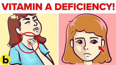 Hidden Signs Of Vitamin A Deficiency You Should Not Ignore Youtube