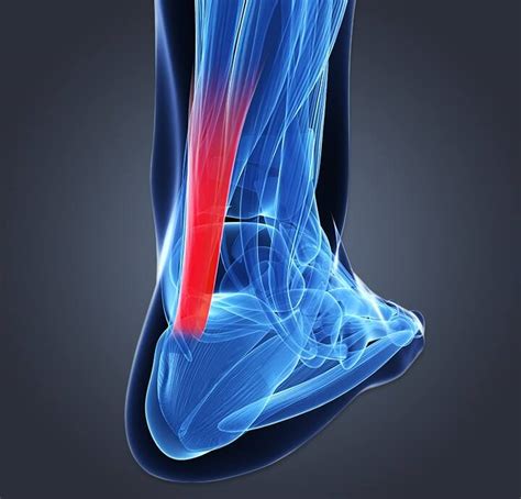 Achilles Tendinitis Heel And Ankle Pain Management Dr Scholls