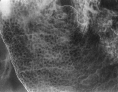 Lymphoid Hyperplasia Of The Stomach Radiographic Findings In Five Adult
