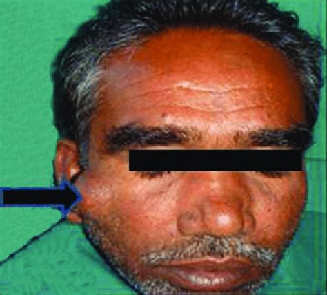 Clinical Photograph Of The Periorbital Swelling Download Scientific