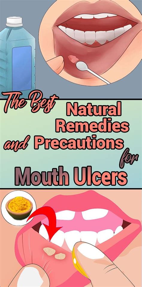 The Best Natural Remedies And Precautions For Mouth Ulcers Mouth