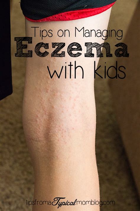 Tips On Managing Eczema With Kids