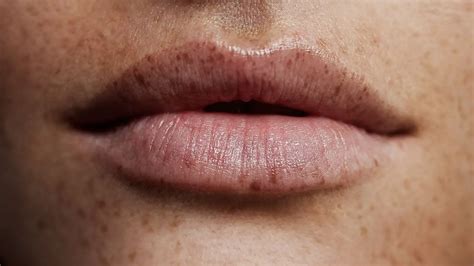 How To Get Rid Of Freckles On Lips 5 Best Experts Remedies