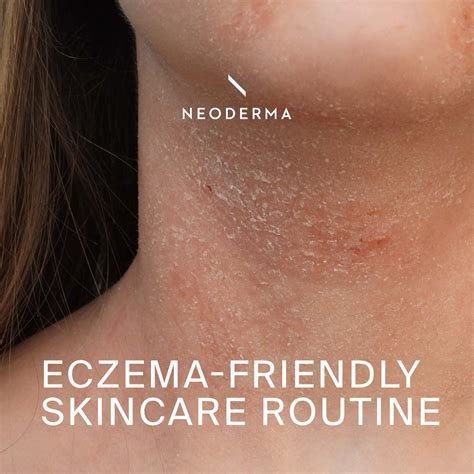 Eczema Friendly Skincare Routine Neoderma