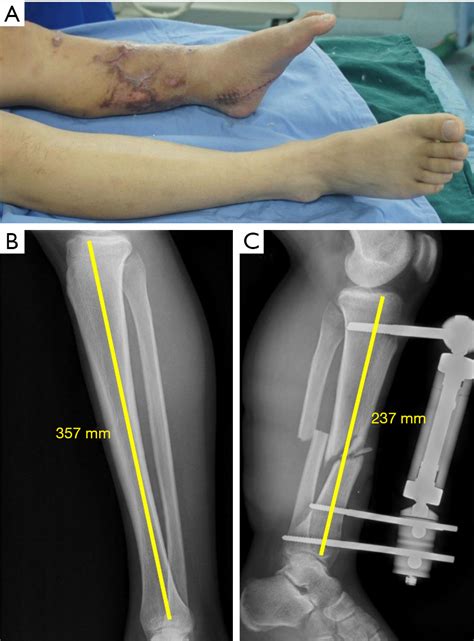 Leg Shortening Surgery