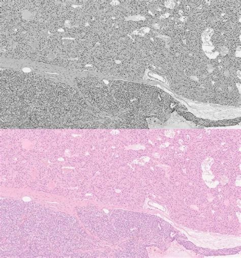 Spontaneous Cervical Haematoma Caused By Extracapsular Haemorrhage From