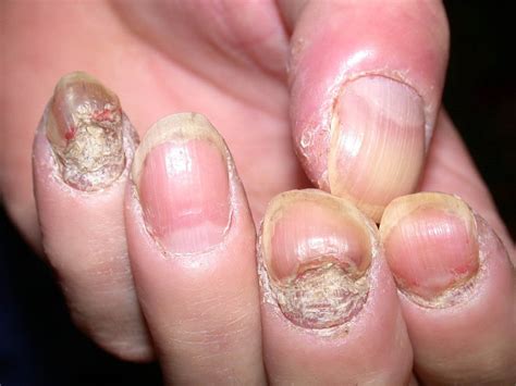 5 Natural Remedies For Psoriasis In The Nails