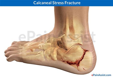 fracture stress calcaneal heel foot calcaneus symptoms pain treatment causes fractures cast plaster ankle bone broken rehab fractured pad signs