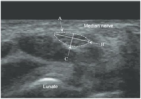 The Transverse Scan View Of An Ultrasound Image Of The Median Nerve