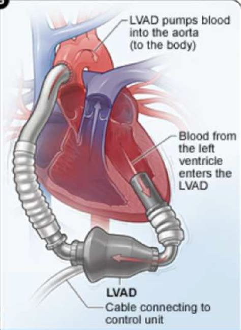 Left Ventricular Assist Device System Download Scientific Diagram