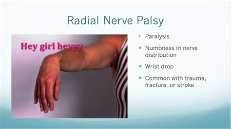 Radial Nerve Entrapment Physical Therapy 101