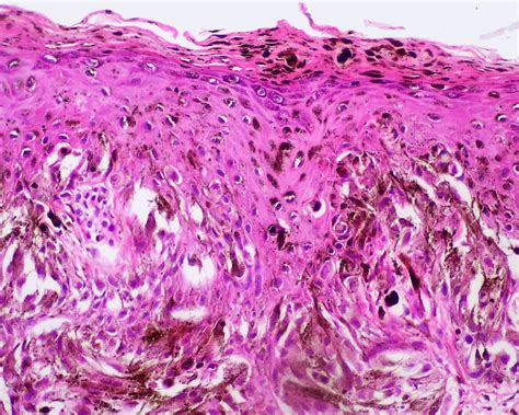 Three Types Of Malignant Skin Tumors
