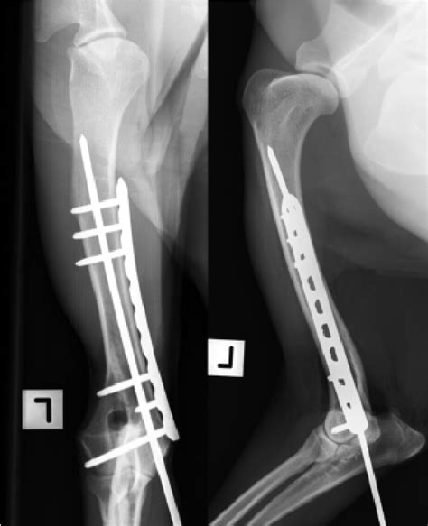 Figure 1 From Distal Normograde Intramedullary Pin And Locking Plate