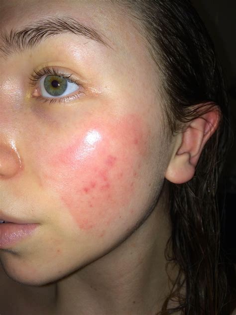 Skin Concerns Tight And Sore Feeling Red Patch On My Face Its Quite