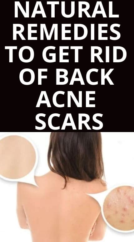 Natural Remedies To Get Rid Of Back Acne Scars